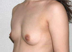 症例3　豊胸術（160ml） 手術前