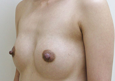 症例4　豊胸術（240ml） 手術後