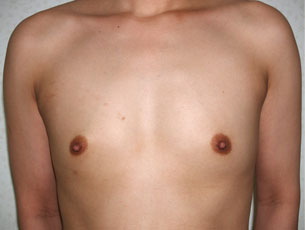 症例6　豊胸術（200ml） 手術前