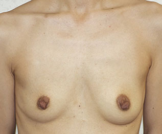 症例7　豊胸術（右180ml　左160ml） 手術前