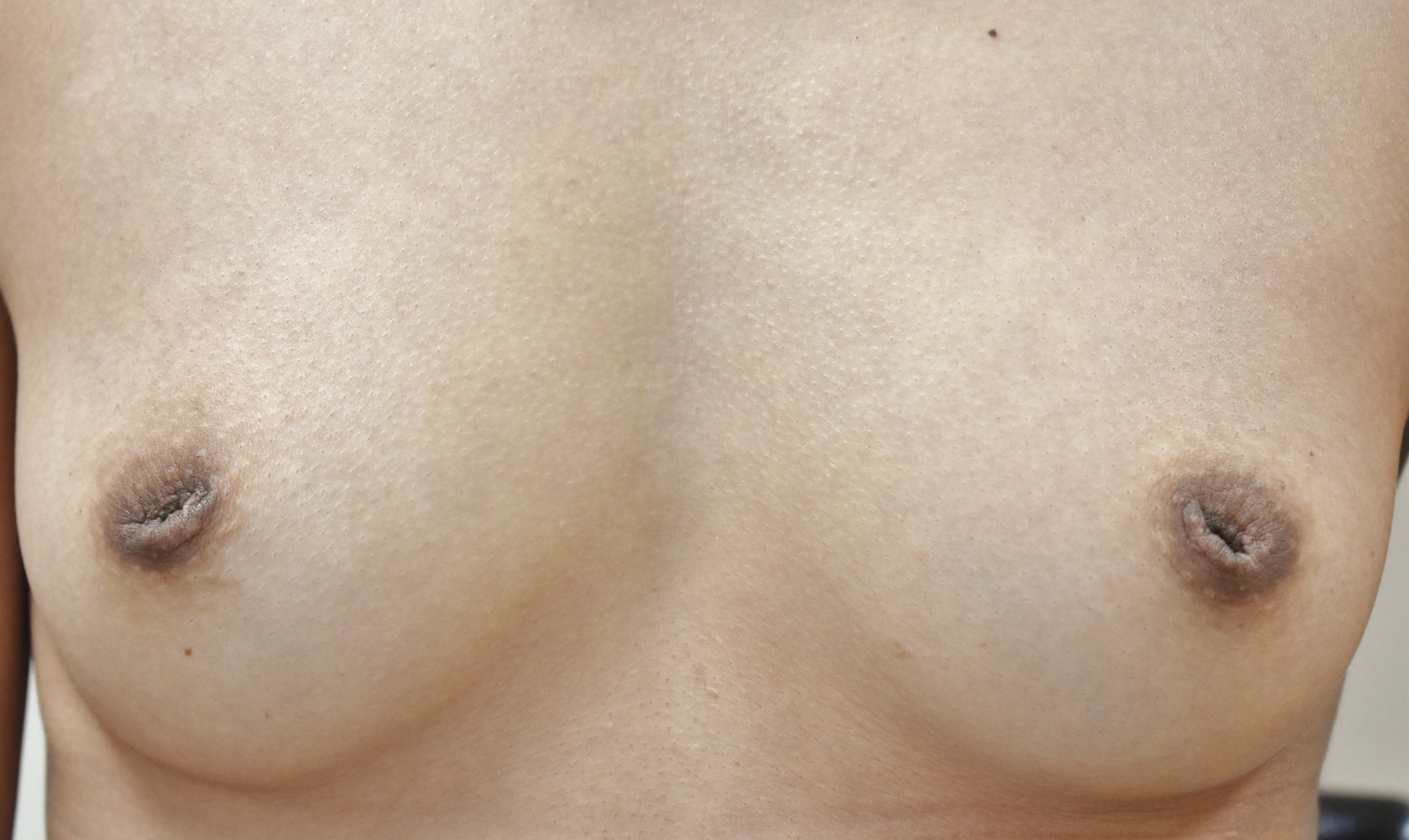 症例2　陥没乳頭修正術 手術前