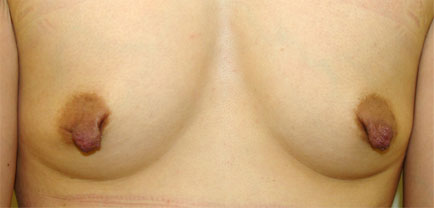 症例4　乳頭縮小・形成術（両側） 手術前