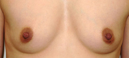 症例4　乳頭縮小・形成術（両側） 手術後