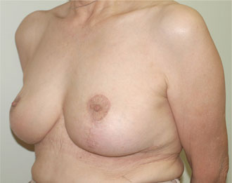症例3　乳房吊り上げ術 手術後