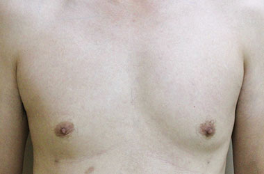 症例1　男性の女性化乳房に対する脂肪吸引 手術後