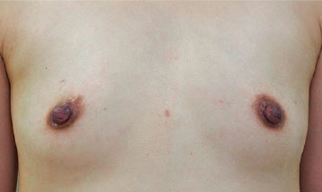症例1　乳頭縮小・形成術（両側） 手術後