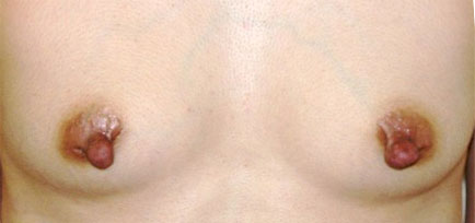 症例3　乳頭縮小・形成術（両側）および豊胸術（160ml） 手術前