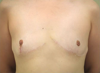 症例2　男性化希望の乳房切除術（性別適合手術）・乳頭縮小術・乳輪縮小術 手術後