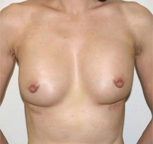 症例11　他院豊胸術後 手術後