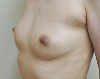 症例17　他院豊胸術後（ヒアルロン酸注入後） 手術前
