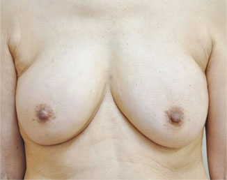 症例3　他院豊胸術後シリコン抜去 手術前