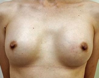 症例4　他院豊胸術後シリコン抜去 手術前