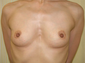 症例1　ヒアルロン酸による豊胸術 治療前