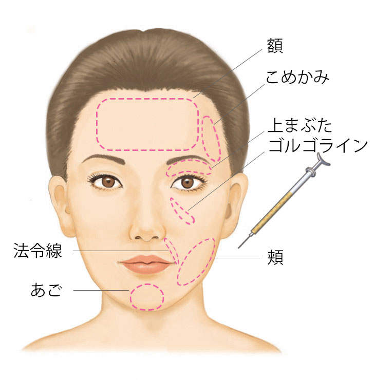 脂肪注入が行える部位