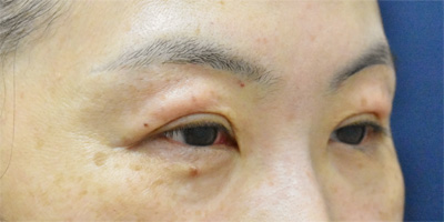 症例2　上まぶた脂肪注入の他院修正 手術前
