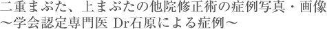 二重まぶた、上まぶたの他院修正術の症例写真・画像〜学会認定専門医 Dr石原による症例〜