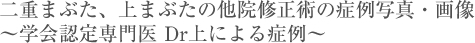 二重まぶた、上まぶたの他院修正術の症例写真・画像~学会認定専門医 Dr上による症例~