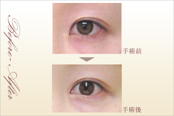 他院目頭切開術後(30歳・女性)症例写真