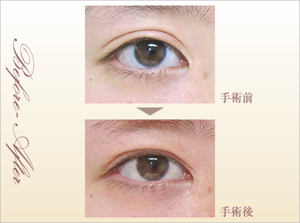 他院二重埋没術後(27歳・女性)症例写真