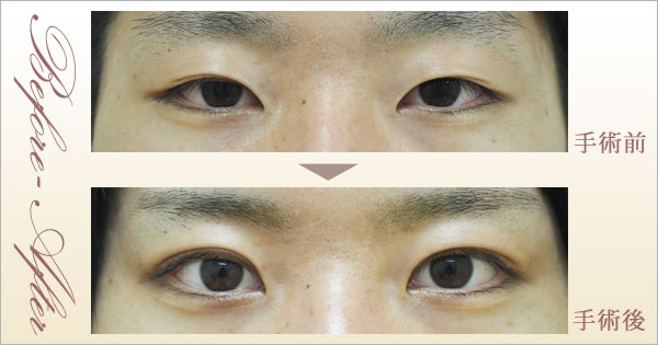 他院二重切開法術後(26歳・女性)症例写真