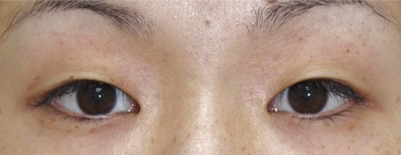 二重埋没法 手術直後の写真 手術前