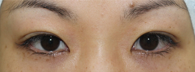 二重埋没法 手術直後の写真 手術直後