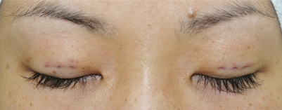 二重埋没法 手術直後の写真手術直後