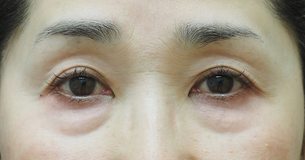 症例17　下まぶたのたるみ⼿術（表ハムラ法） 手術前