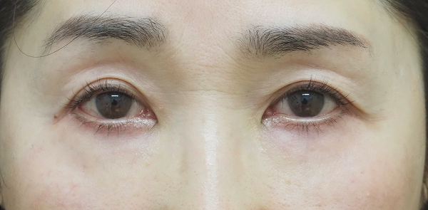 症例17　下まぶたのたるみ⼿術（表ハムラ法） 手術後