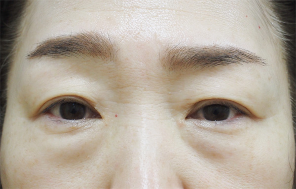 症例18　下まぶたのたるみ⼿術（表ハムラ法）・上まぶたのたるみ手術（眉毛下切開） 手術前