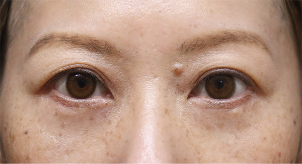 症例19　下まぶたのたるみ⼿術 手術後