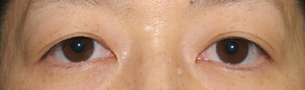 症例2　上まぶたのたるみ手術＋眼瞼下垂 手術前