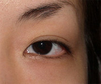 症例3　眼瞼下垂（左） 手術前