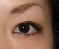 症例3　眼瞼下垂（左） 手術後