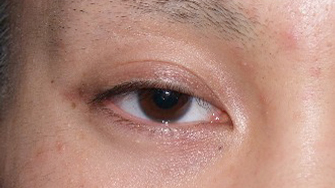 症例4　眼瞼下垂（右） 手術前
