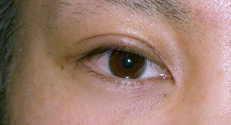 症例4　眼瞼下垂（右） 手術後