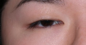 症例5　眼瞼下垂（右） 手術前