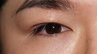 症例5　眼瞼下垂（右） 手術後