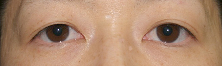 症例7　上まぶたのたるみ手術＋眼瞼下垂 手術前