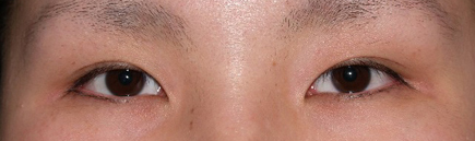 症例8　眼瞼下垂 手術前