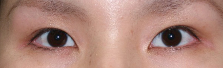 症例8　眼瞼下垂 手術後