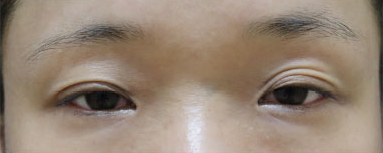 症例9　眼瞼下垂 手術前