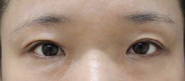 症例9　眼瞼下垂 手術後