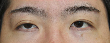 症例10　眼瞼下垂 手術前