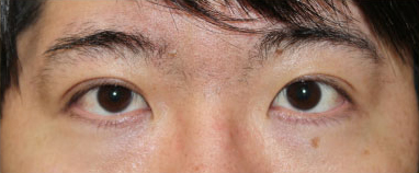 症例10　眼瞼下垂 手術後