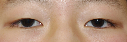 症例1　二重まぶた（切開法）・眼瞼下垂（両側） 手術前