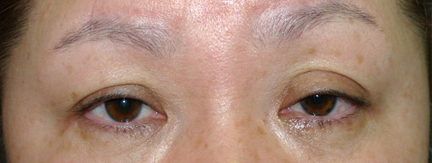 片側だけにみえる眼瞼下垂に対して、正しく両目の眼瞼下垂手術を行った写真～Dr.石原の症例～ 手術前