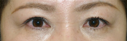 片側だけにみえる眼瞼下垂に対して、正しく両目の眼瞼下垂手術を行った写真～Dr.石原の症例～ 手術後