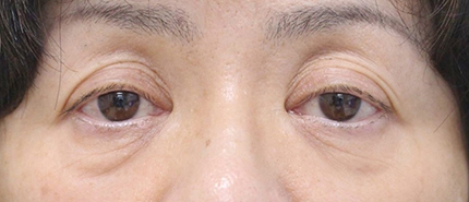 症例2　眼瞼下垂（両側） 手術前