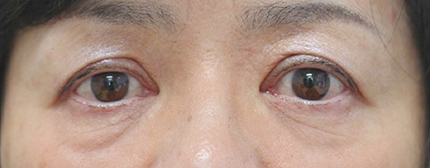 症例2　眼瞼下垂（両側） 手術後